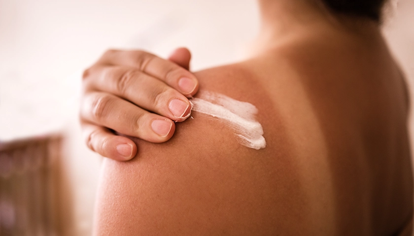 Aplicación de aftersun en hombros y espalda enrojecidos por quemadura solar.webp