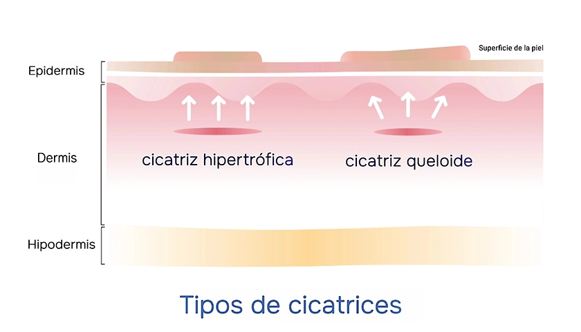 Infografía comparativa entre cicatriz hipertrófica y queloide en la piel.